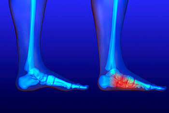 Flat feet treatment in the Middle (Central) Tennessee: Nashville, TN 37211, Smyrna, TN 37167, Spring Hill, TN 37174, Columbia, TN 38401, Dickson, TN 37055, Fairview, TN 37062 and Hohenwald, TN 38462 areas